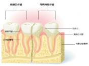 不同程的牙周病度要怎麼治療