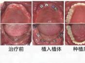 修復多顆牙齒缺失的種類價格